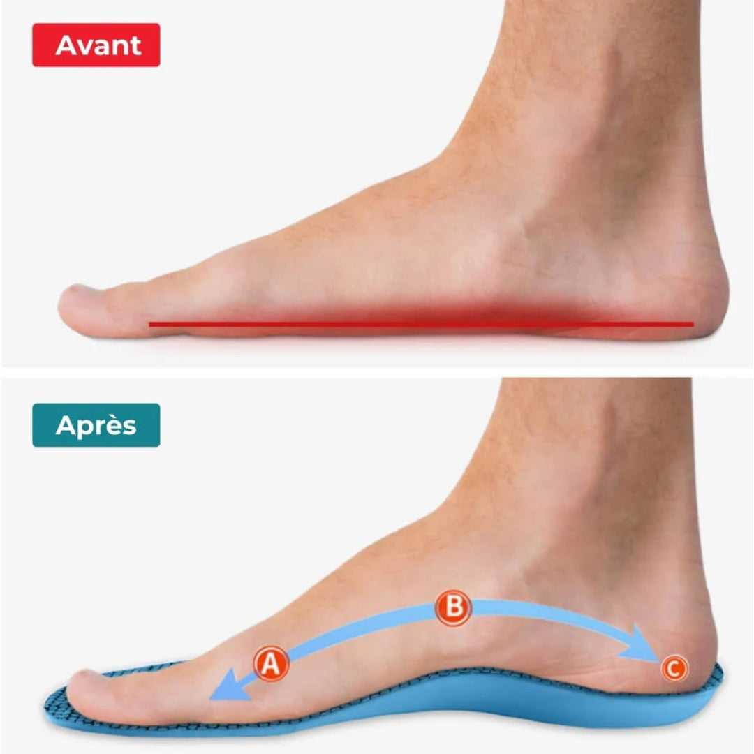 Semelles orthopédiques hallux valgus