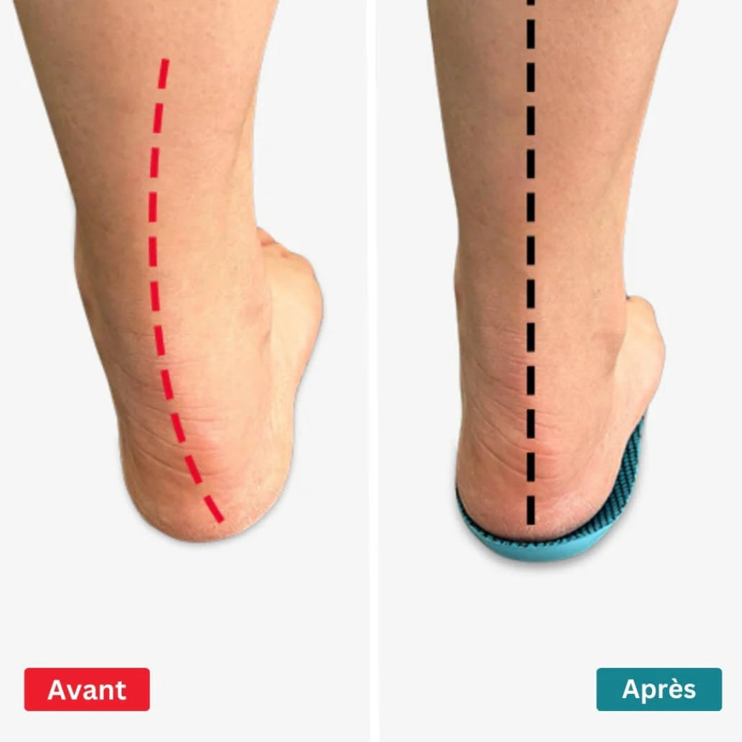 Semelles orthopédiques hallux valgus